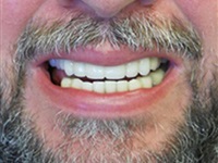 Four Implants can restore a beautiful smile!
