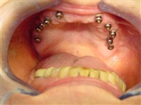 Implants replaced full upper denture scmandds