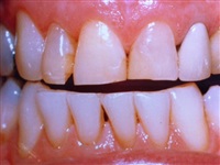 Un-even Discolored Teeth Before 