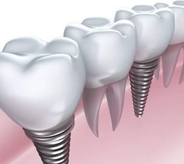 Dental Implants Holtsville