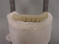 Implants restore function & confidence. 