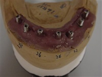 Patient won't wear lower denture, solution implants. 