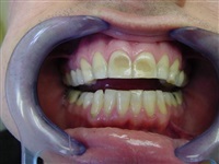 Teeth damaged from orthodontics 