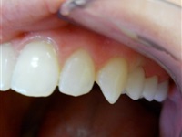 Metal free bridge, alternative to implant. 