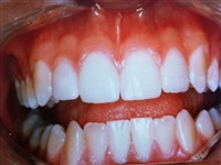 Porcelain Veneers After 