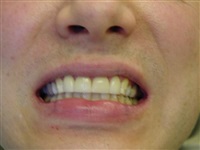 Solution, Zirconia Veneers 