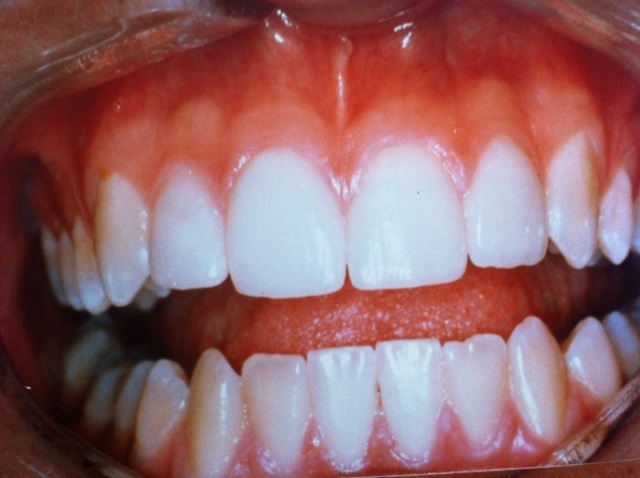 Porcelain Veneers